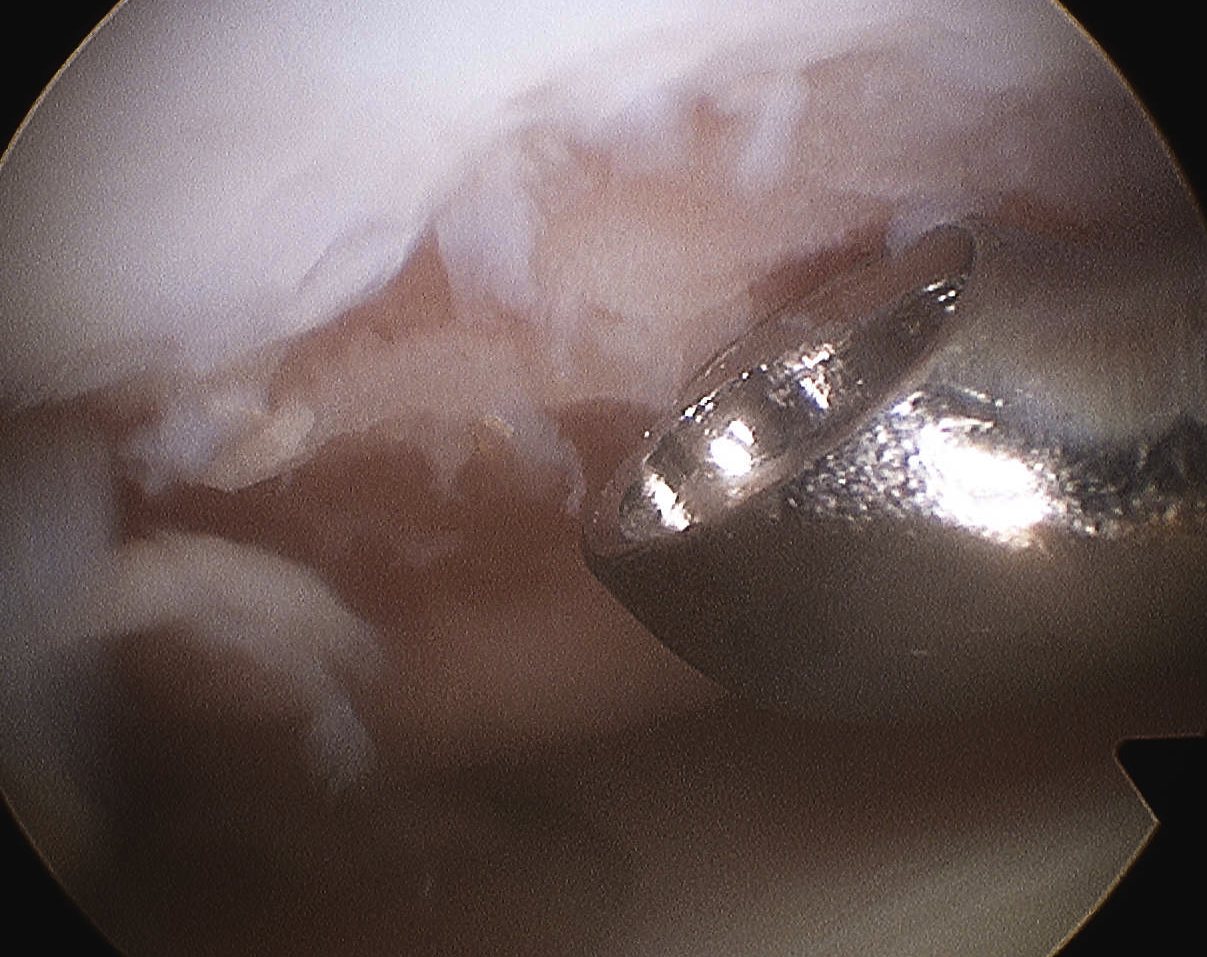 Microfracture Currette Base